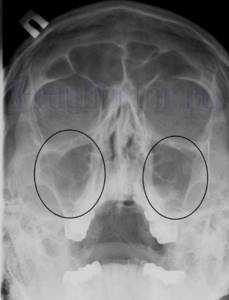 Гайморит на рентгеновском снимке пазух носа: как определить болезнь