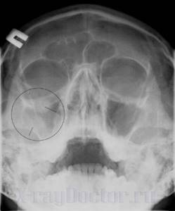 Гайморит на рентгеновском снимке пазух носа: как определить болезнь
