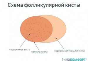 Механизм развития кисты желтого тела Механизм развития кисты желтого тела