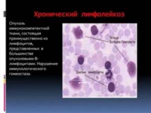 Лимфобластный лейкоз