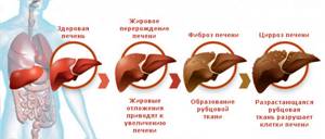 Общие сведения о циррозе печени и классификация