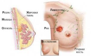 Выживаемость при раке молочной железы и сколько живут с раком груди по прогнозам?