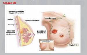 Рак молочной железы стадии