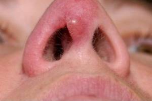 Доброкачественные опухоли носа и придаточных околоносовых пазух