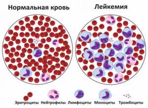 Разновидности острого лейкоза