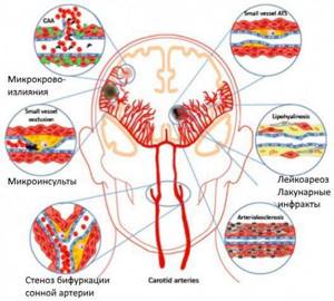 Патогенез сосудистой деменции