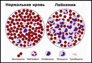 Общее описание лейкоза Общее описание лейкоза