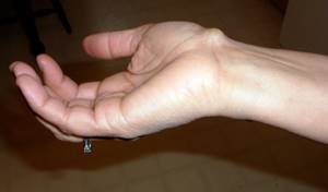 Гигрома кисти руки: причины возникновения, лечение
