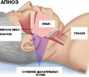 Лечение апноэ во сне народными средствами