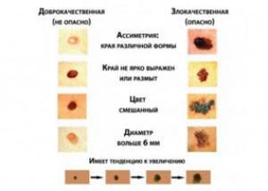 Меланома слизистых оболочек головы и шеи: рта и носа